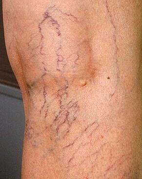 Manifestaciones de varices en las piernas. 