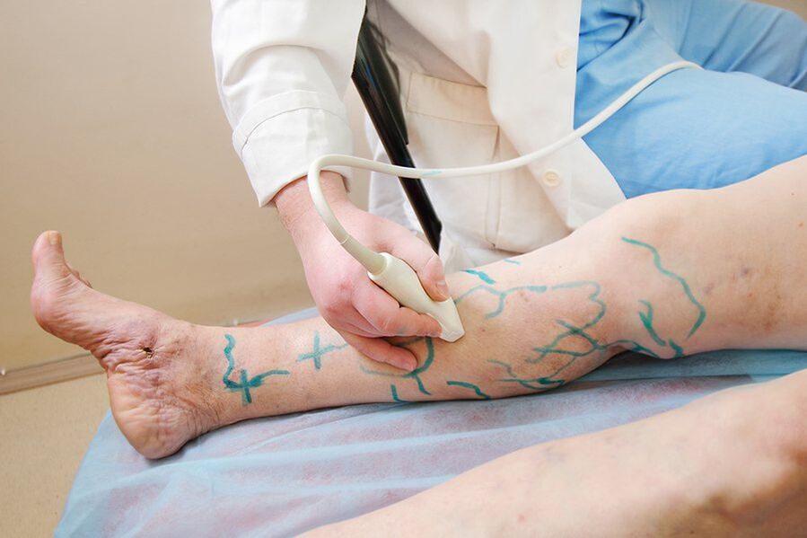 Preparación para miniflebectomía marca en las perforaciones de la parte inferior de la pierna, realización de ecografía